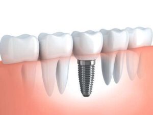 Illustration of Successfully Installed Dental Implants.