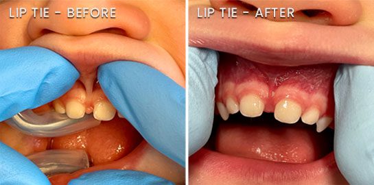 Bear Brook Dental Care lip tie before and after images
