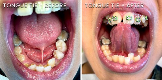 Bear Brook Dental Care tongue tie before and after images