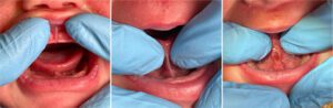 Bear Brook Dental tongue tie CO2 laser treatment